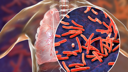 tuberculosis bacteria in illustrated lung